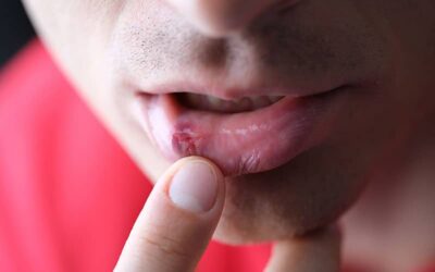 Herpes Zoster o Culebrilla