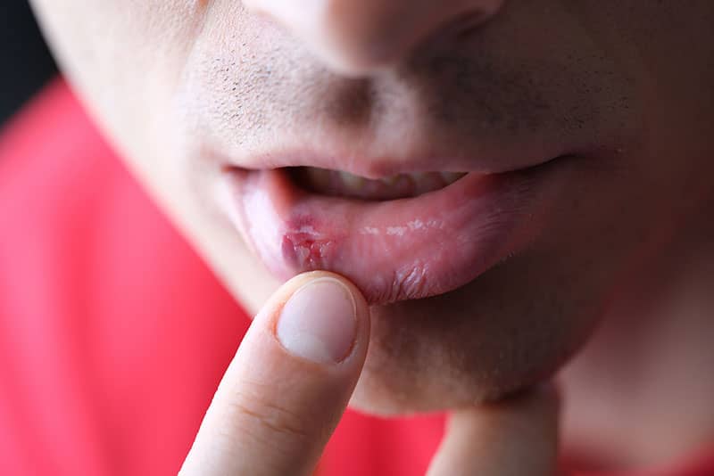 Herpes Zoster o Culebrilla