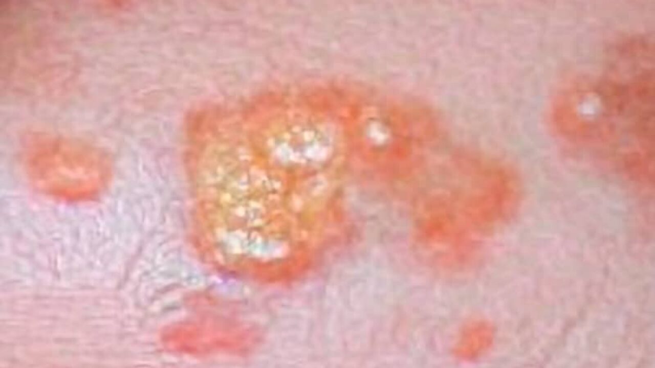 tratamiento de cicatrices molusco contagioso