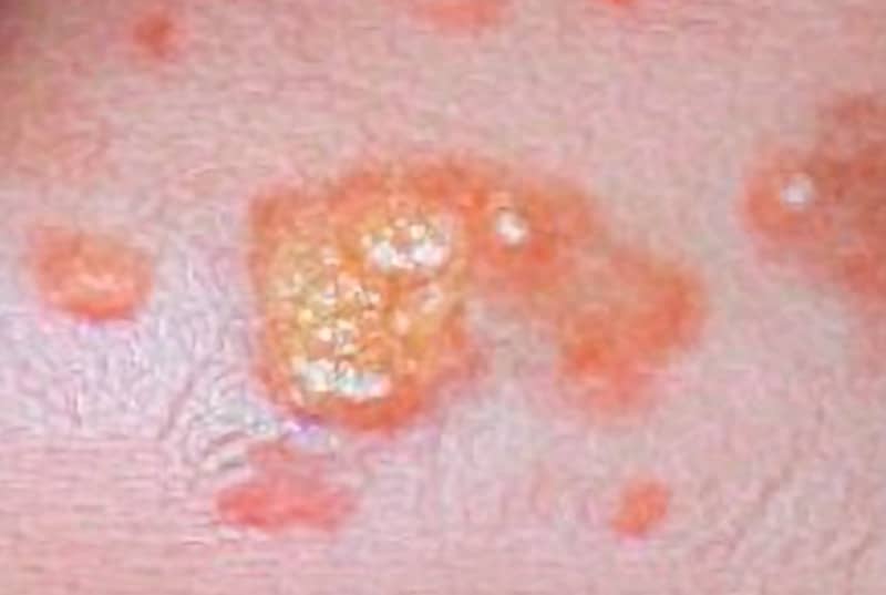 El molusco contagioso