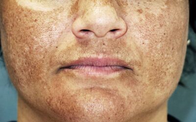 MELASMA Y SU TRATAMIENTO