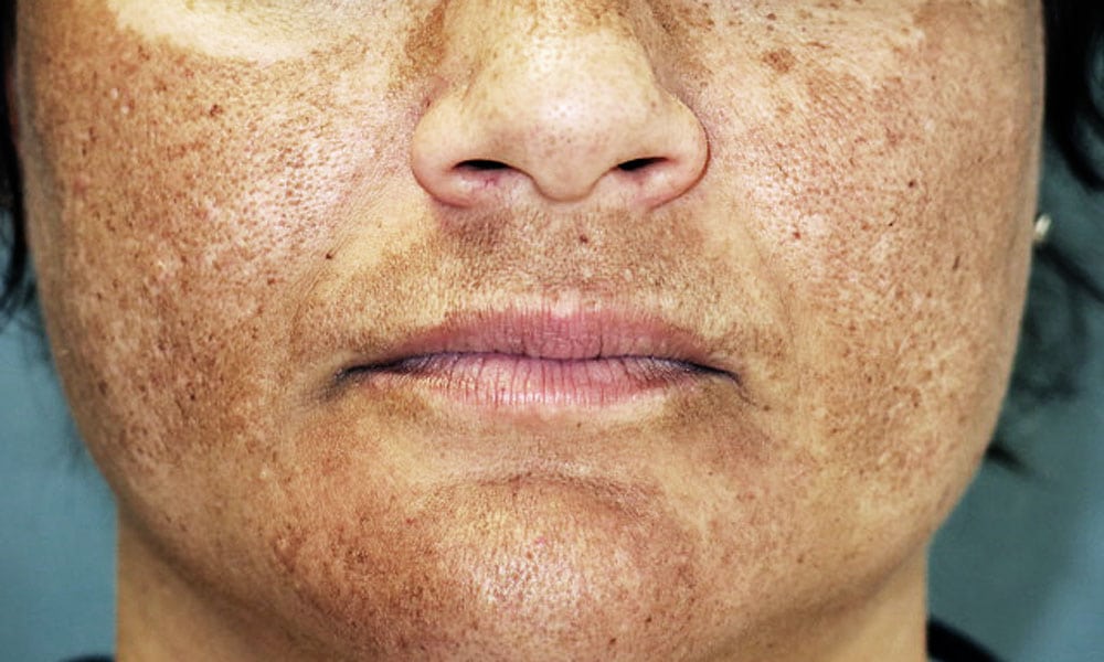 MELASMA Y SU TRATAMIENTO