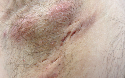 HIDRADENITIS SUPURATIVA