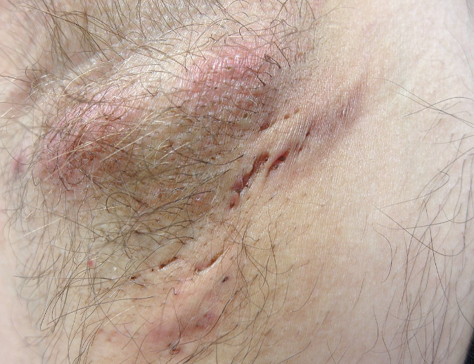 HIDRADENITIS SUPURATIVA