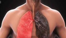 ENFERMEDAD PULMONAR OBSTRUCTIVA